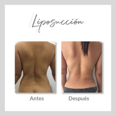 Liposucción