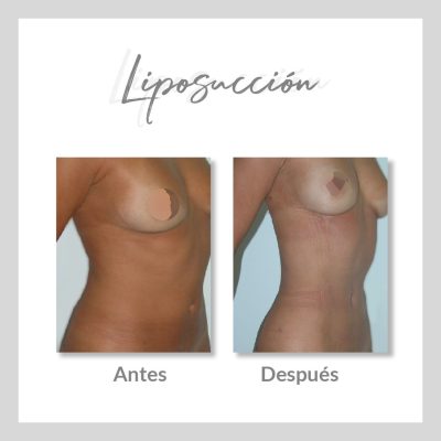 Liposucción