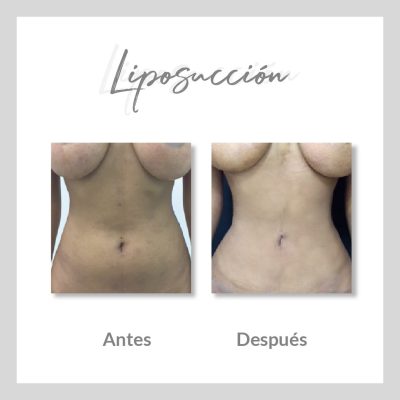 Liposucción