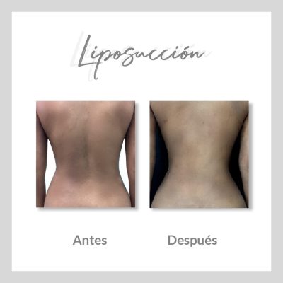 Liposucción