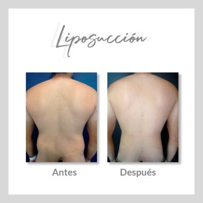 Liposucción