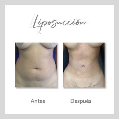 Liposucción
