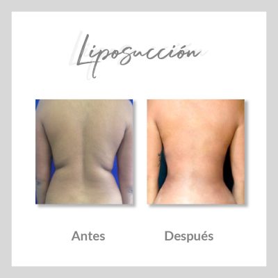 Liposucción