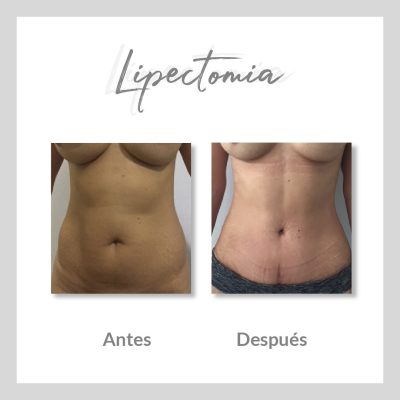 Lipectomía