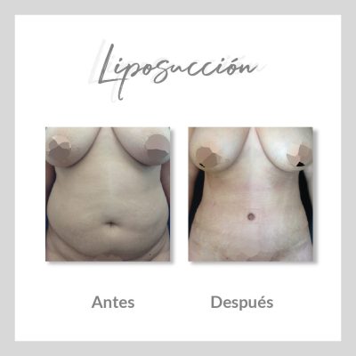 Liposucción