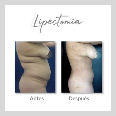 Lipectomía