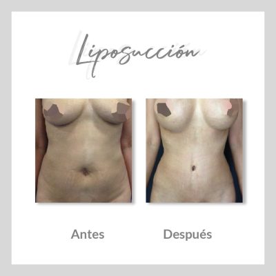 Liposucción