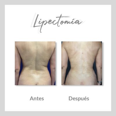 Lipectomía