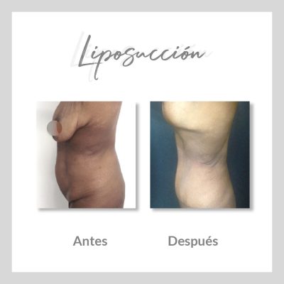 Liposucción