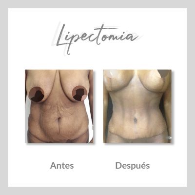 Lipectomía